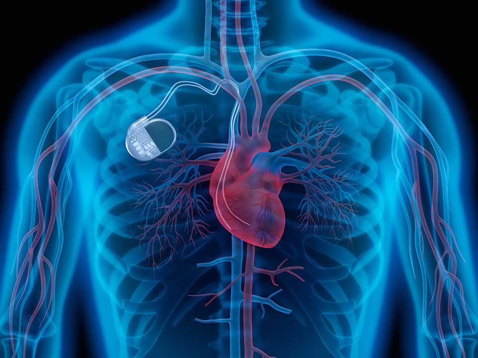 Herzschrittmacher / Defibrillator Kontrolle